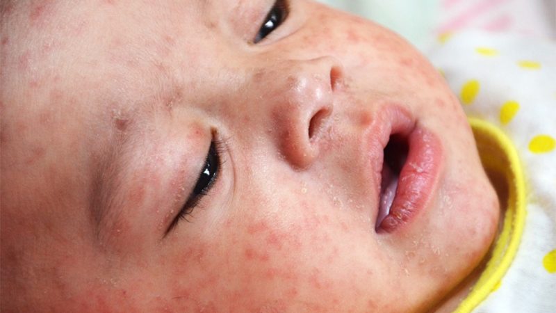 Measles in Children: Symptoms and Treatment