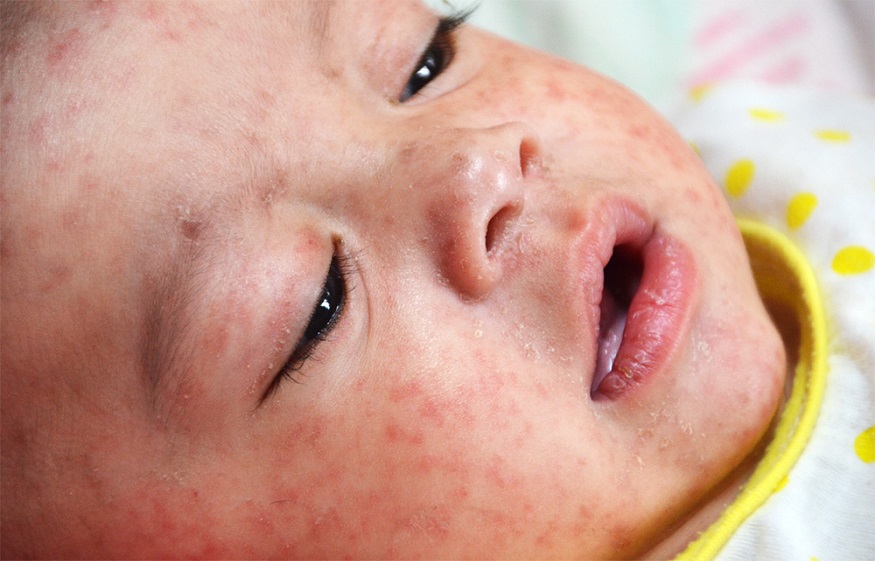 Measles in Children: Symptoms and Treatment